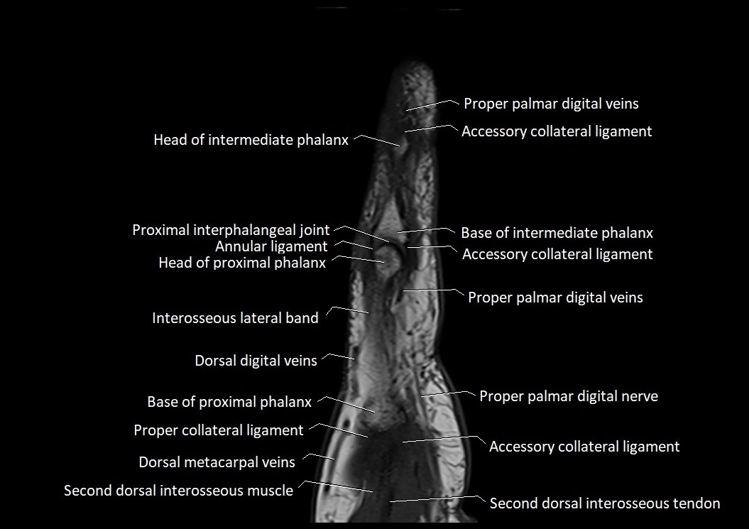 Finger anatomy sagittall cross section 3T image 3.webp